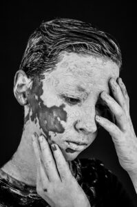 デリケートゾーンの黒ずみや色素沈着を改善する方法は？